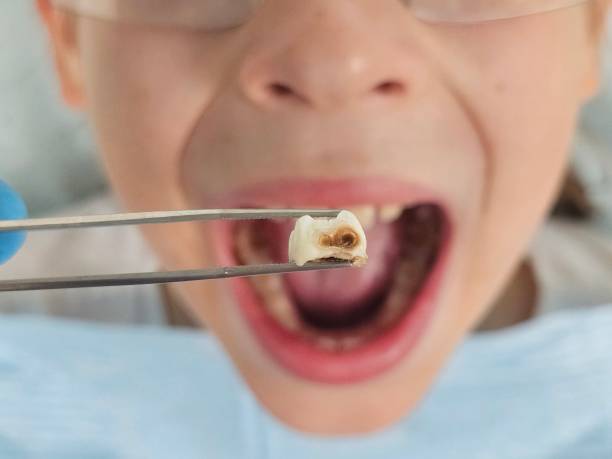 Best Emergency Dental Care for Broken or Chipped Teeth in Bear Rocks, PA